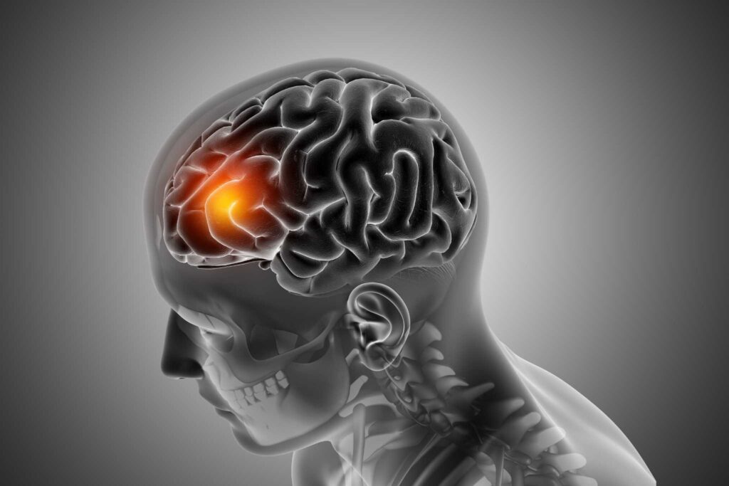 Cabeça meningite